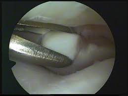 Beitragsbild Arthroskopie